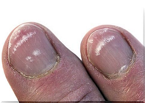 Nails indicate a problem if they are cracked