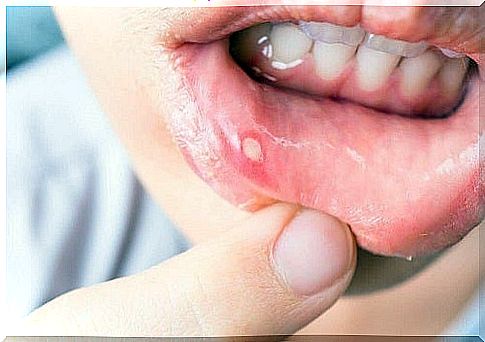 7 natural remedies for healing canker sores