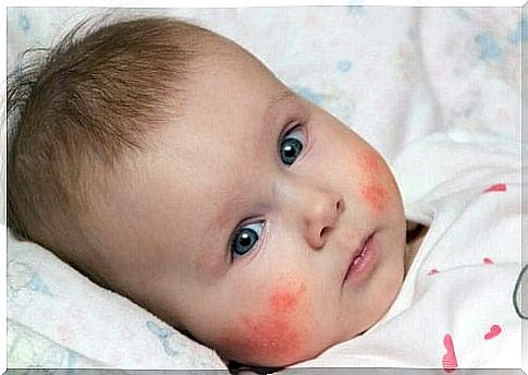 Baby with rash on his face