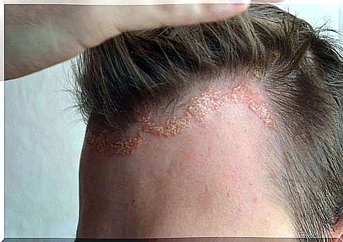 Boy with psoriasis