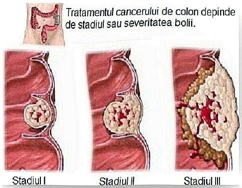 Information about colon cancer