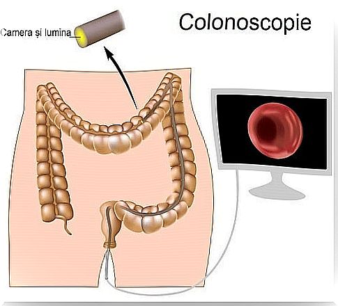 Information on colon cancer and colonoscopy