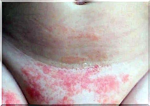 Dermatitis in children