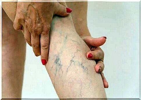 Description, symptoms and treatments for phlebitis