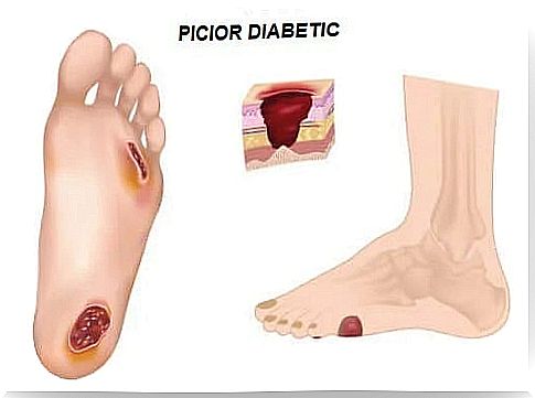 Diabetic foot with injuries