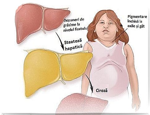 We need to treat hepatic steatosis from breakfast