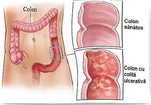 Home remedies for ulcerative colitis