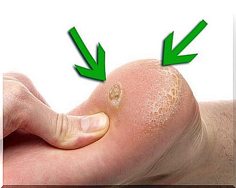 How to naturally treat warts and calluses