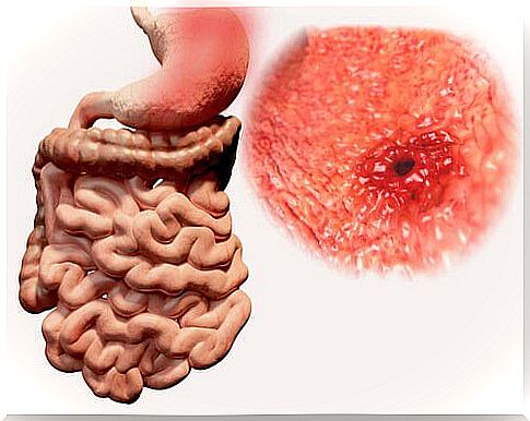 Gases can be a symptom of gastroduodenal ulcer