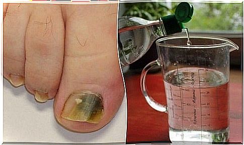 Natural remedy for nail fungus