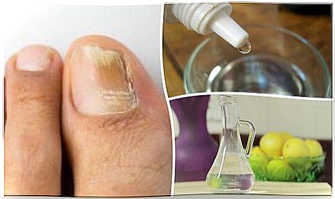 Natural remedy for onychomycosis from 3 ingredients