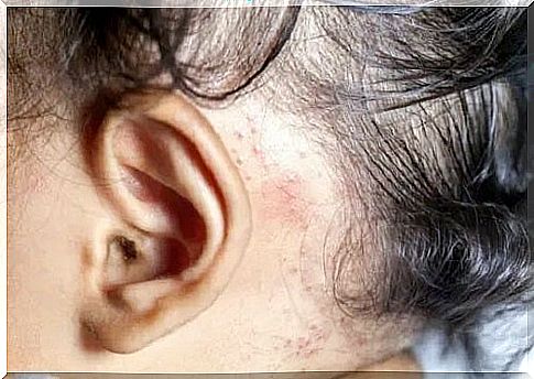 Psoriasis in children on the scalp