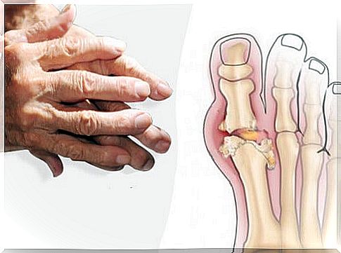 Some types of treatment for arthritis