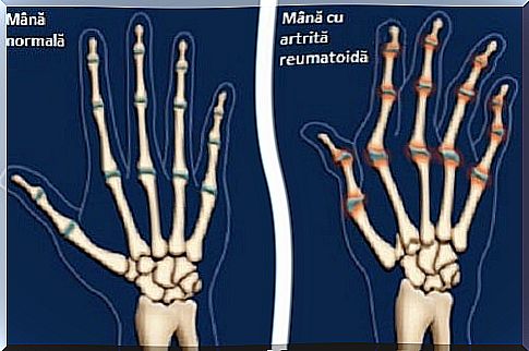 Arthritis of the hands