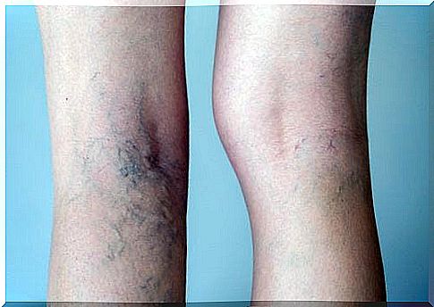 Treatment of varicose veins with medicinal teas