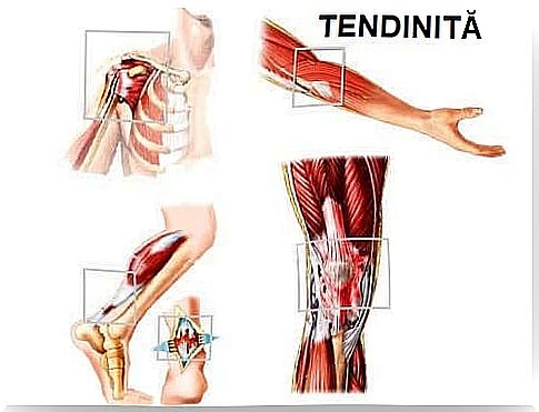 Graphical representation of tendonitis