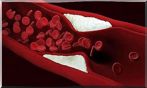 Aging of blood vessels too fast