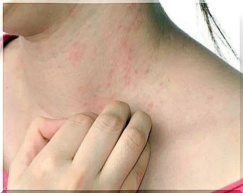 Woman with atopic dermatitis